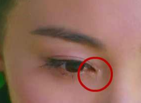 開(kāi)眼角要增生多久？