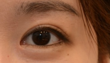 開眼角有效果嗎？開眼角有哪些危害？