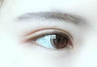 開眼角有幾種方法?開眼角有后遺癥嗎？