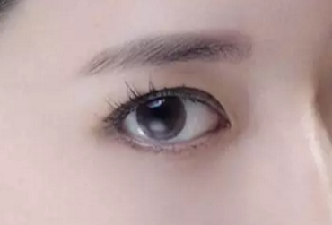 開眼角術(shù)后多久才能恢復(fù)？開眼角術(shù)后防止疤痕增生怎么做？