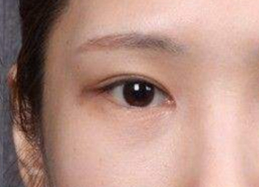 開(kāi)眼角的術(shù)后護(hù)理方法有哪些？