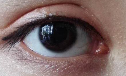 開外眼角什么價(jià)格？開外眼角什么時(shí)候能好？