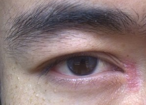 開眼角術(shù)后如何快速消腫？