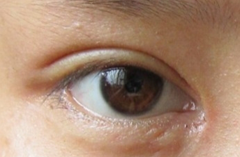 開(kāi)眼角手術(shù)會(huì)不會(huì)留疤？開(kāi)眼角手術(shù)后應(yīng)該注意什么？