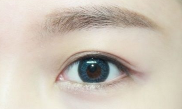 開眼角需要注意的事項有哪些？
