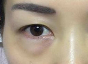 光纖溶脂去眼袋術(shù)后如何護(hù)理？