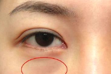 光纖溶脂祛眼袋需要多少錢？光纖溶脂怎么樣呢？