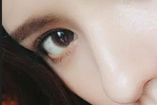 開眼角發(fā)紅怎么辦？