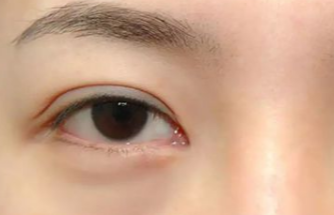 激光去眼袋多久做一次？激光去除眼袋后遺癥有哪些？