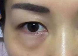 激光可以祛眼袋嗎？激光祛眼袋有哪些副作用？
