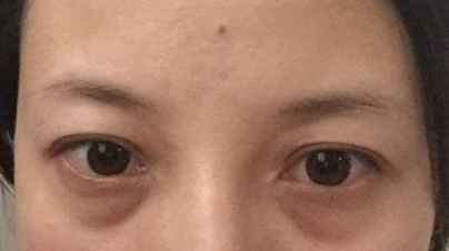 激光祛除眼袋有效嗎？激光祛眼袋有什么利弊？