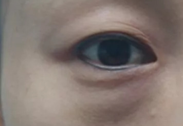 激光去眼袋可以管多久？