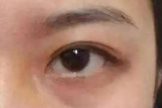 激光祛眼袋效果真的好嗎？激光去眼袋會有風險嗎？