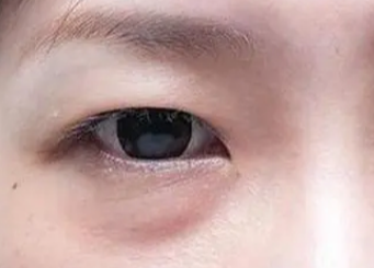 激光去眼袋要多長(zhǎng)時(shí)間？做激光去眼袋手術(shù)要多久？