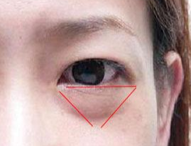 激光除眼袋效果如何？激光去眼袋要注意什么？