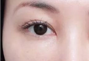 激光去眼袋什么人適合？