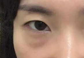 激光祛眼袋會(huì)疼嗎？激光去眼袋手術(shù)好嗎？