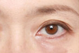 激光去眼袋幾天能恢復？激光去眼袋是怎樣的？