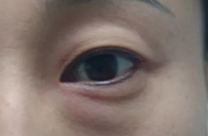 激光去除眼袋效果好不好？