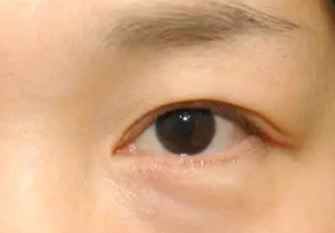激光去眼袋術(shù)后會不會反彈？激光去眼袋術(shù)后注意事項？