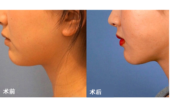 面部吸脂后皮膚會不會松弛？