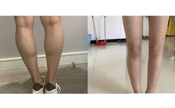 瘦腿針和吸脂哪個好？