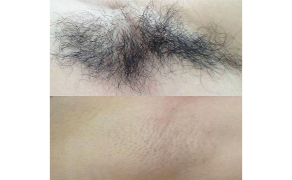 激光脫腋毛疼嗎？