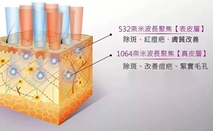 皮秒祛斑恢復(fù)期多久？