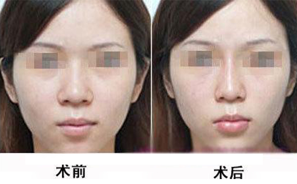 鼻頭縮小手術(shù)是怎么做的？術(shù)后應(yīng)該怎么護(hù)理