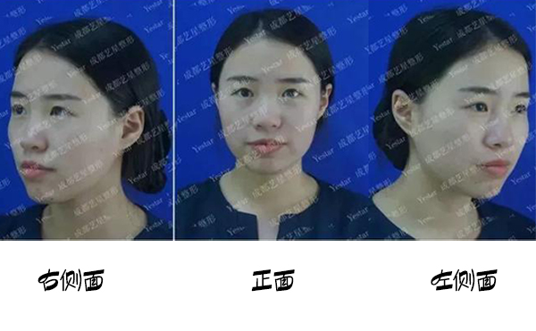 福州名韓整形改善蒜頭鼻大概要花多少錢？