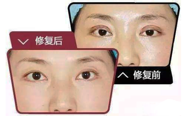 哪些情況需做雙眼皮修復(fù)？修復(fù)難度大不大?