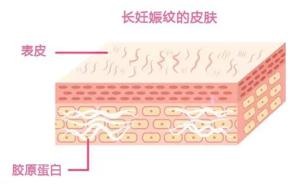 妊娠紋是怎么形成的？