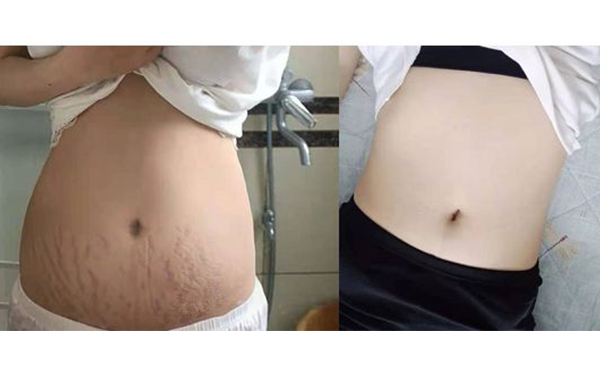 激光可以去除妊娠紋嗎？