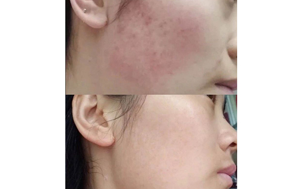 彩光嫩膚會(huì)讓皮膚變薄嗎？