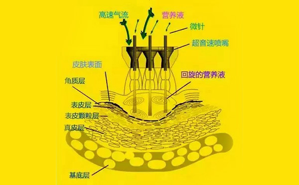  無(wú)針?biāo)忉樖窃趺醋龅?效果怎么樣?