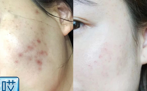 激光美白能安全嗎？