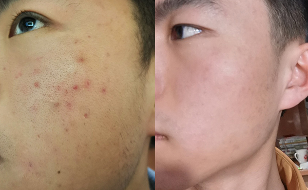 白瓷娃娃每次治療間隔多久？