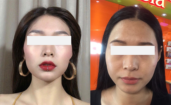 激光脫發(fā)際線效果怎么樣？