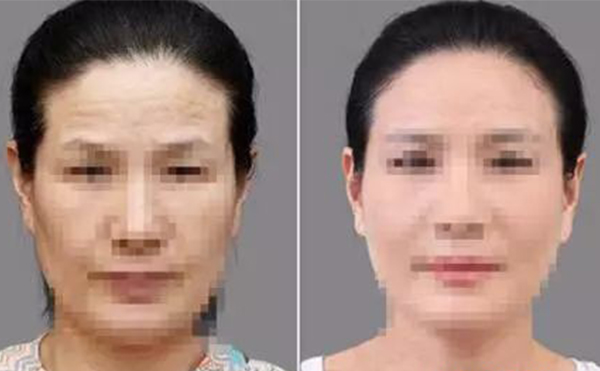 激光除皺有什么優(yōu)勢？