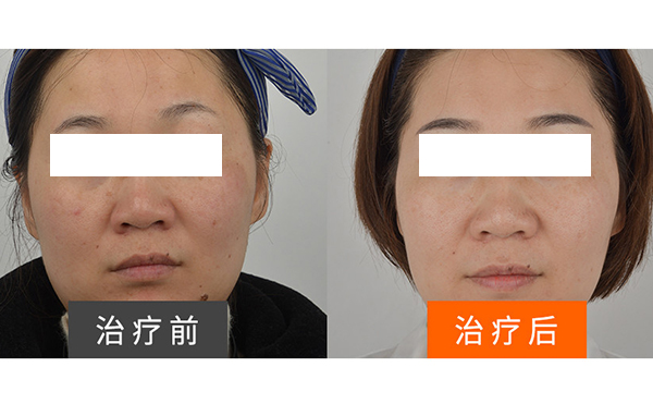 彩光嫩膚安全不安全？