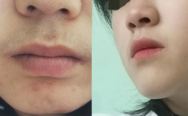 激光脫毛的效果怎么樣？