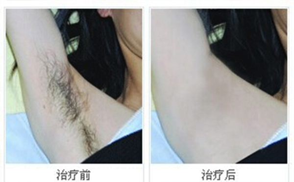 冰點脫腋毛安全嗎？