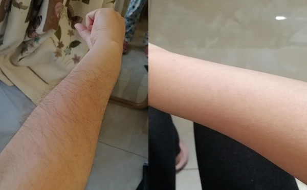 光子手臂脫毛幾次能脫完？