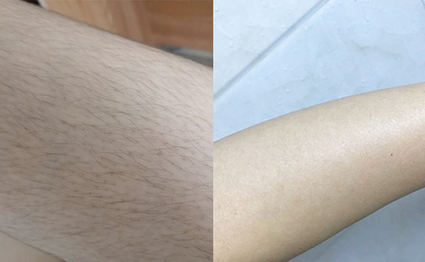 激光手臂脫毛安全嗎？