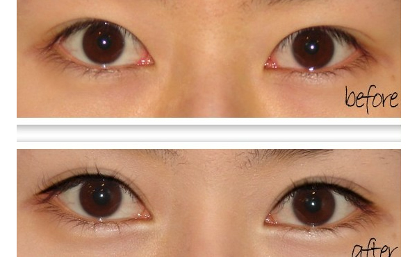 開眼角手術(shù)有什么原則？