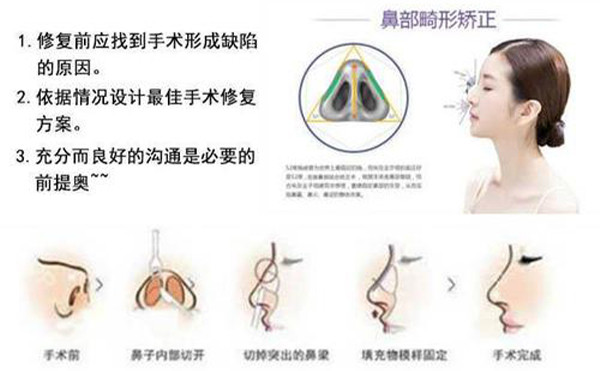 隆鼻修復(fù)效果怎么樣？
