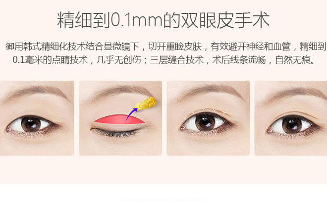韓式三點雙眼皮一般要多少錢？