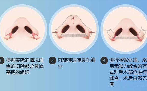 鼻翼縮小手術(shù)有用嗎？