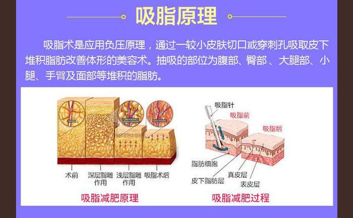 水動力吸脂效果好嗎？