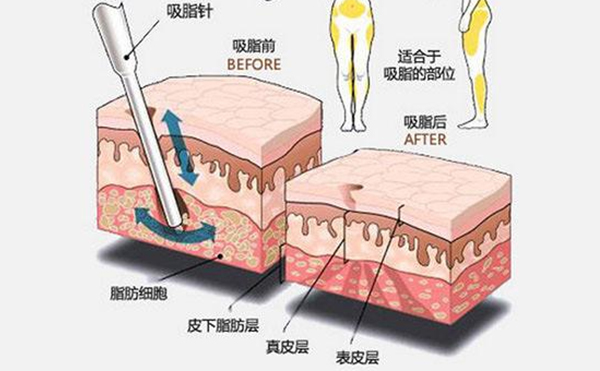 大腿吸脂有什么優(yōu)點？